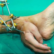 Китайские врачи пришили отрезанную руку пациента ему на ногу