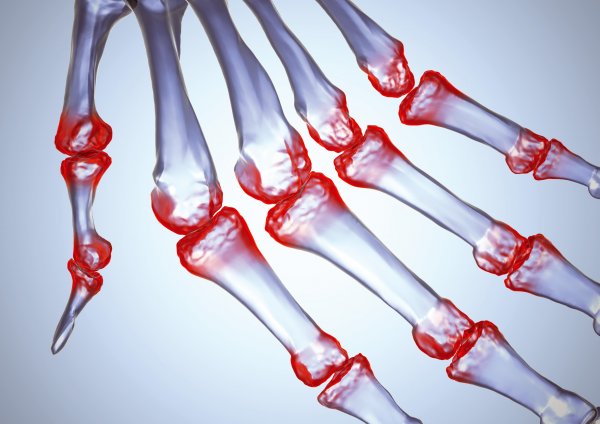 Ученые: Парацетамол не помогает в лечении артрита