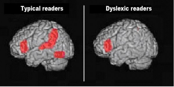 Дислексию можно преодолеть тренировками мозга – Ученые