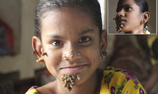 «Древесная» девочка живет в Бангладеш