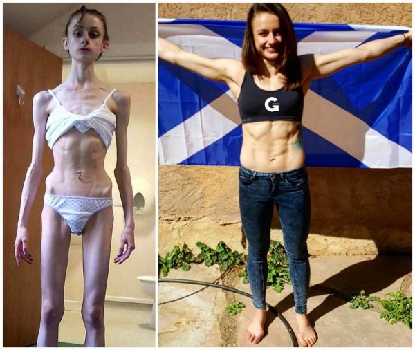 Несмотря на анорексию, девушка стала бойцом ММА