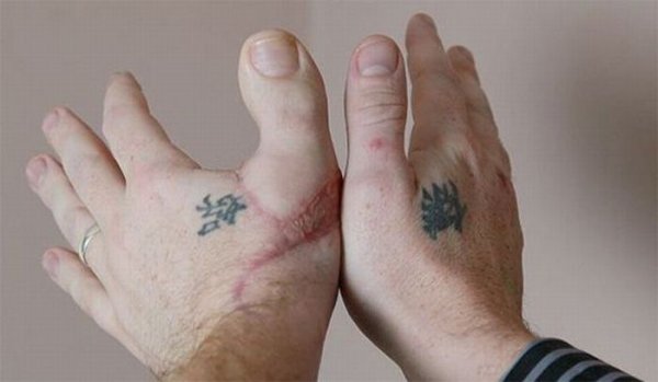 В Томске хирурги пересадили пациенту большой палец ноги на кисть руки