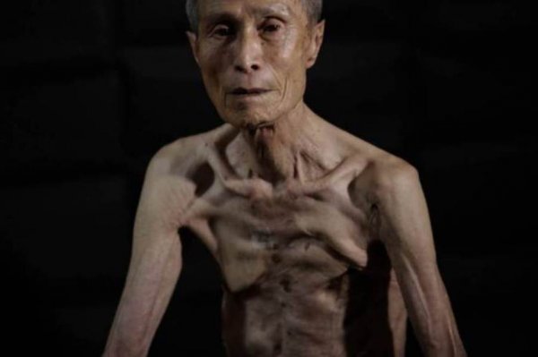 Японец на своем теле показал следы ядерного удара по Нагасаки