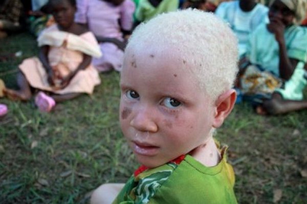 В Малави расчленяют детей альбиносов