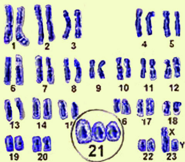 Набор дауна. Синдром Дауна 21 хромосома. Синдром Дауна набор хромосом. Кариотип трисомии 21. Синдром Дауна трисомия 21 хромосомы.