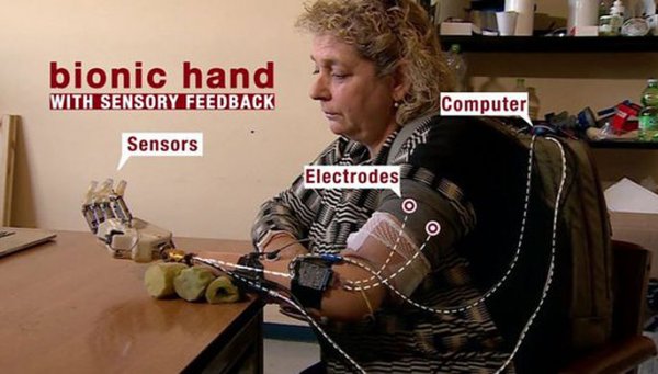 Впервые в Италии женщине установили бионический протез руки