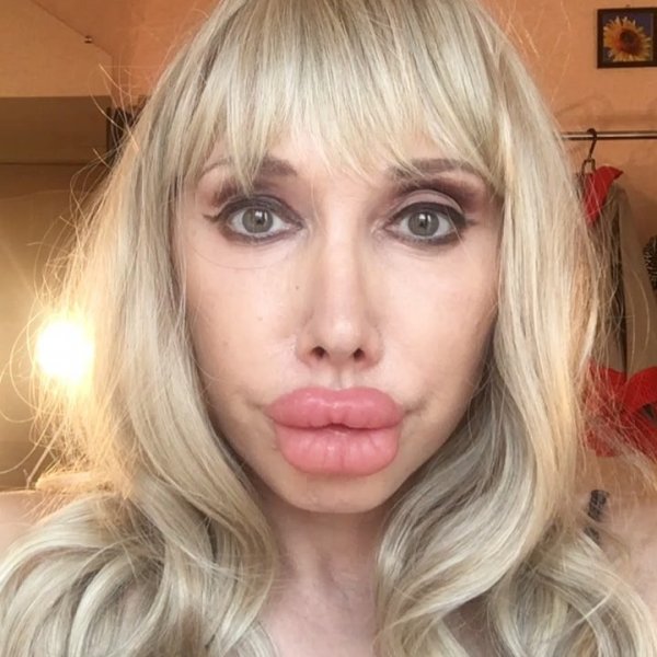 Как Лобода: Опухшие губы Елены Воробей вызвали у фанатов отвращение