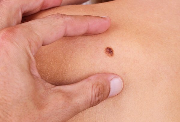 Учёные заявили, что меланомный рак кожи более опасен немеланомного