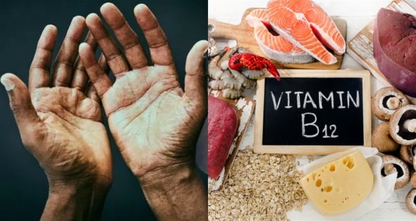 Названы скрытые симптомы критической нехватки витамина В12 для организма
